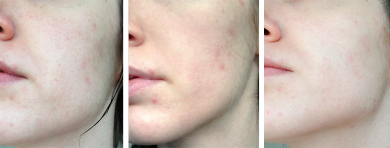 FAIIINT reviews ESPA Enzyme Facial at Creme Hair & Beauty Salon Oakham Leicestershire, before & after treatment photos